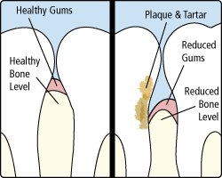 periodontitis treatment in alexandria va