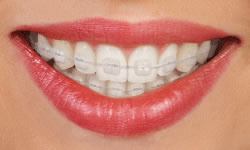 clear braces in alexandria va