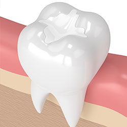 tooth fillings in alexandria va