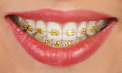 gold braces in alexandria va