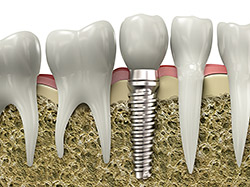 tooth implants in alexandria va