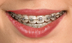 self-ligating braces in alexandria va