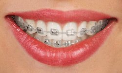 metal braces in alexandria va