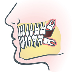 wisdom teeth in alexandria va